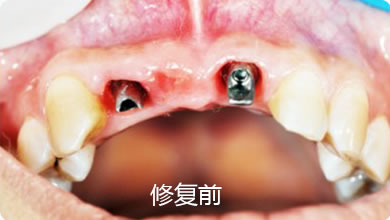 多数牙缺失修复案例2