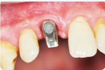 单颗牙缺失修复案例
