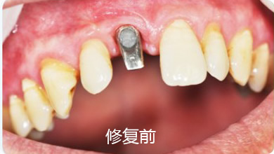 单颗牙缺失修复案例1