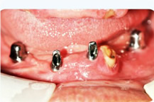 半口牙缺失修复案例1