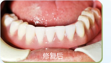 半口牙缺失修复案例3